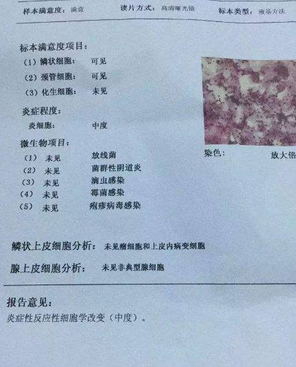 阴道分泌物91视频在线看厂家教你查看阴道分泌物检测报告