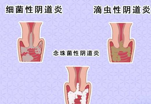 阴道分泌物91视频在线看剖析什么是细菌性阴道炎