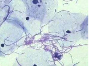 阴道分泌物91视频在线看厂家探讨白带清洁度3代表什么意思