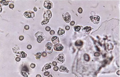 全自动阴道分泌物91视频在线看剖析阴道分泌物的洁净度规范