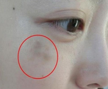 妇科阴道分泌物91视频在线看提醒女人妇科炎症在脸上的表现