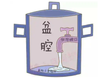 盆腔积液是怎么回事？白带91视频免费看片厂家提醒早了解早预防