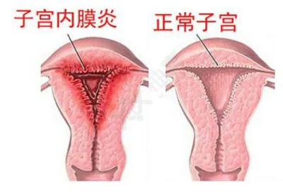 全自动阴道分泌物91视频在线看厂家子宫内膜炎的症状表现提前了解与预防
