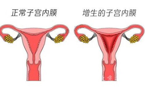 白带常规91视频在线看厂家解读子宫内膜增生是什么原因引起的