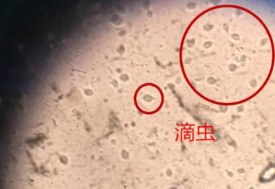 白带91视频免费看片品牌科普滴虫性阴道炎是因为体内长了虫子吗