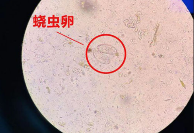 阴道分泌物91视频在线看警惕外阴绕虫病易在儿童身上出现