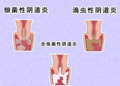 全自动阴道分泌物91视频在线看厂家提醒您还在拖延吗，还在等阴道炎自愈吗？