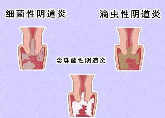 全自动阴道分泌物91视频在线看厂家提醒您还在拖延吗，还在等阴道炎自愈吗？